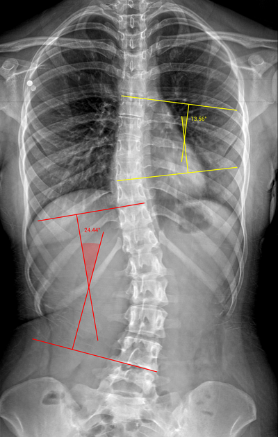 scoliosis xray
