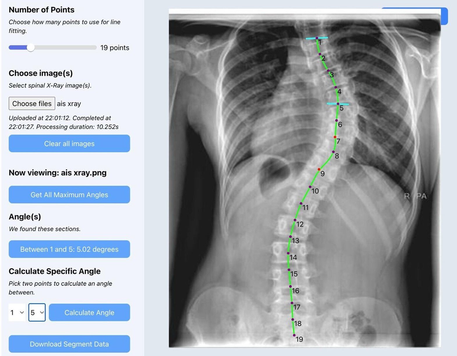the ai algorithm is able to accurately detect multiple curves on a plain coronal scoliosis